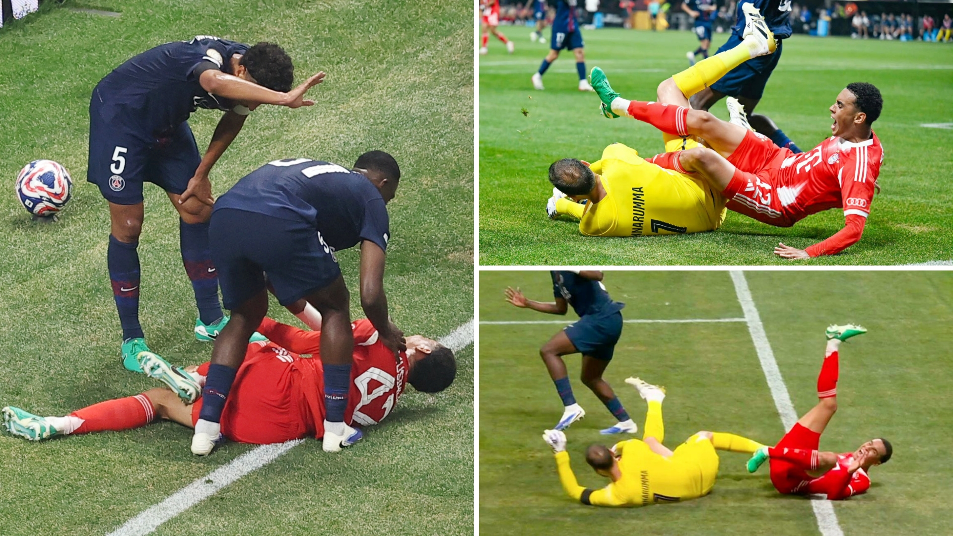 官方：穆西亚拉腓骨骨折且踝关节脱臼将接受手术治疗的简单介绍